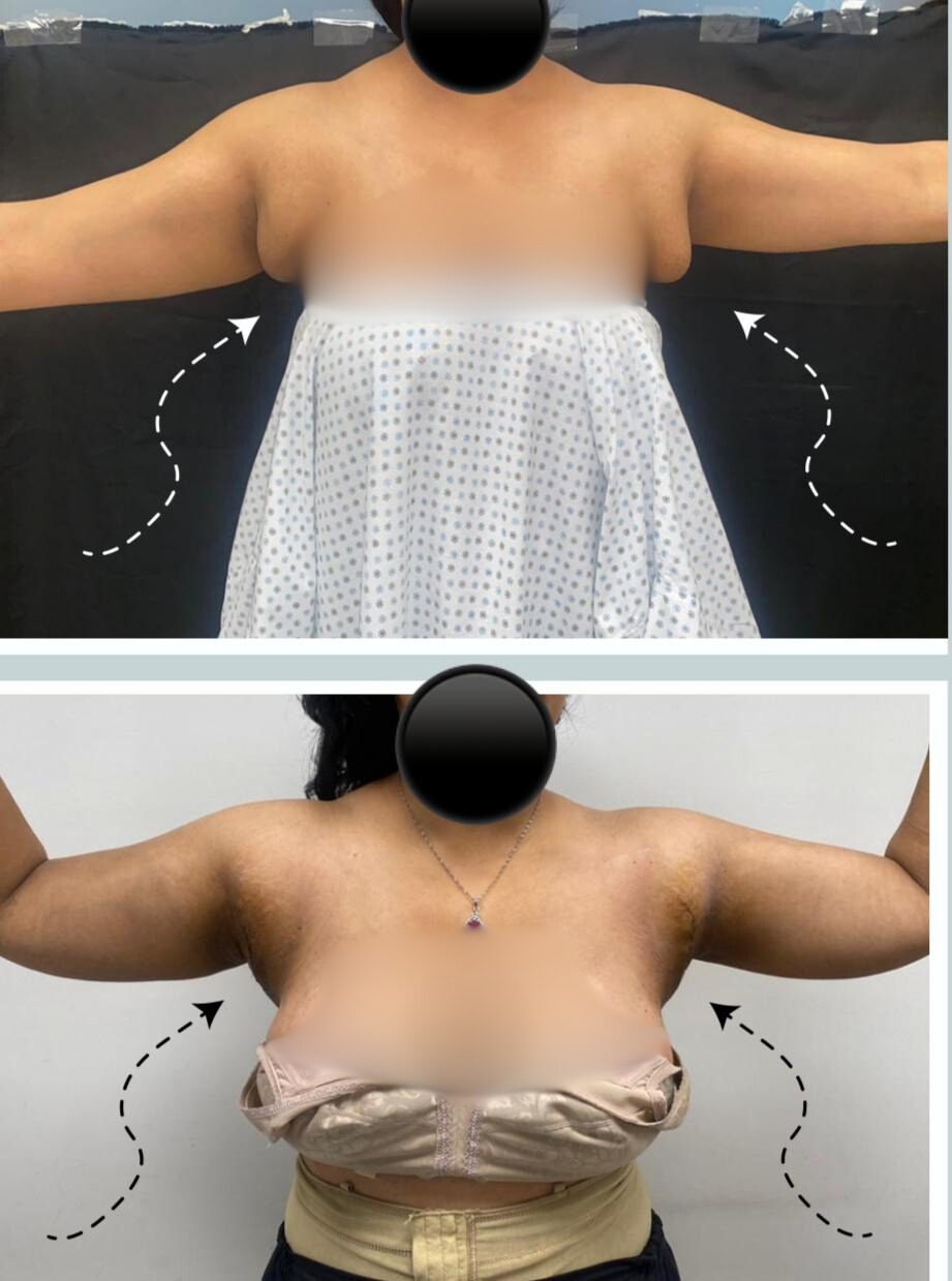 Axillary Breast Fat