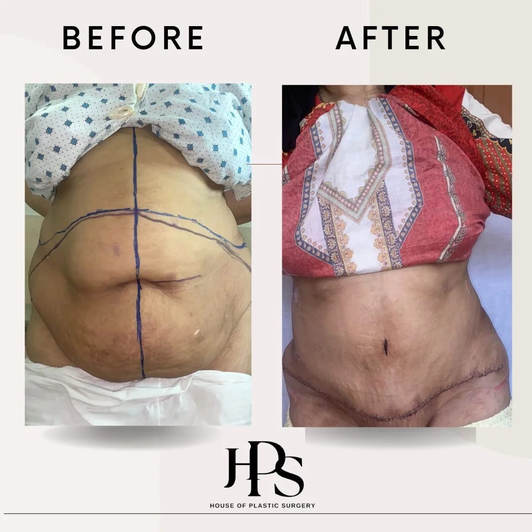 tummy tuck surgery